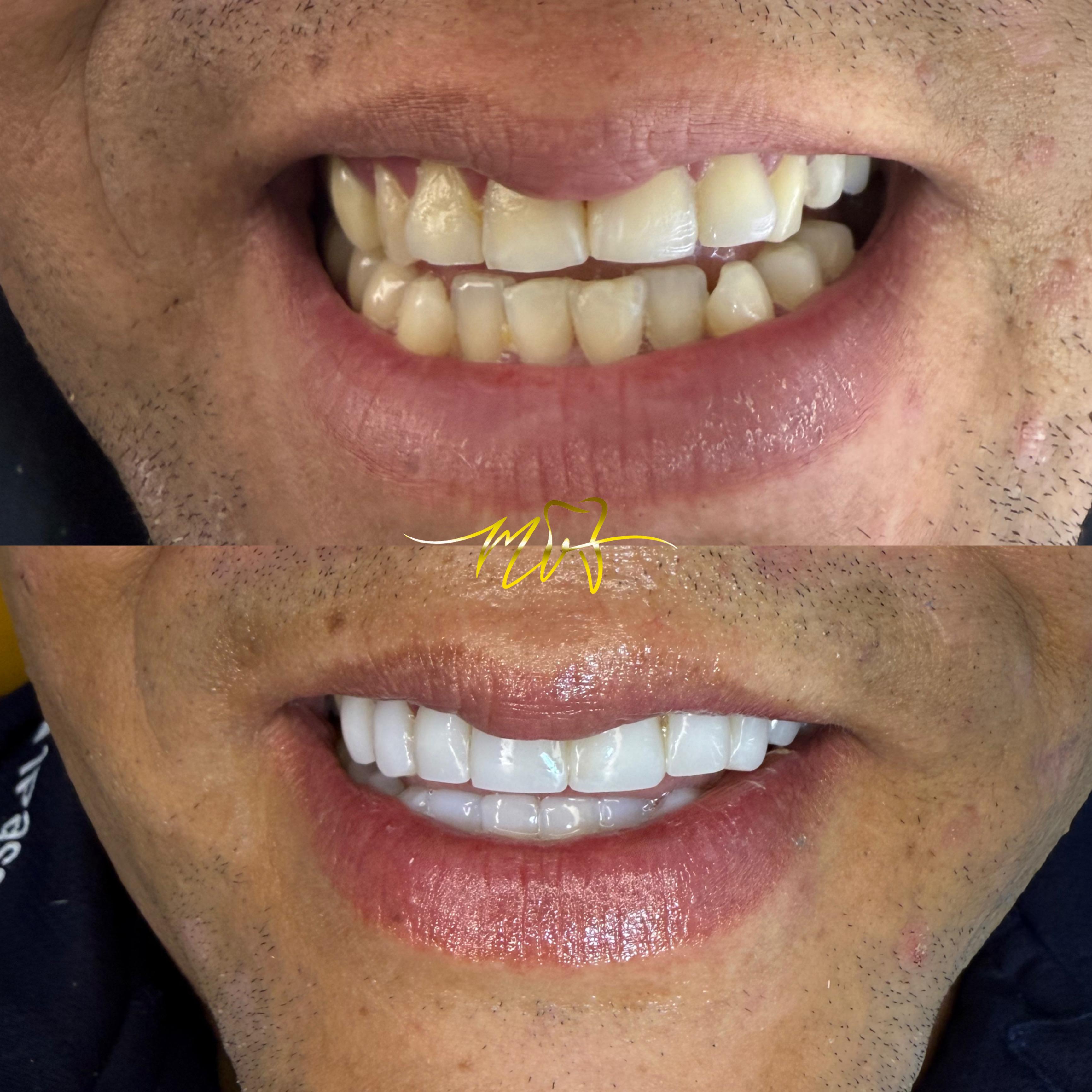 Caso de diseño de sonrisa, vista 2