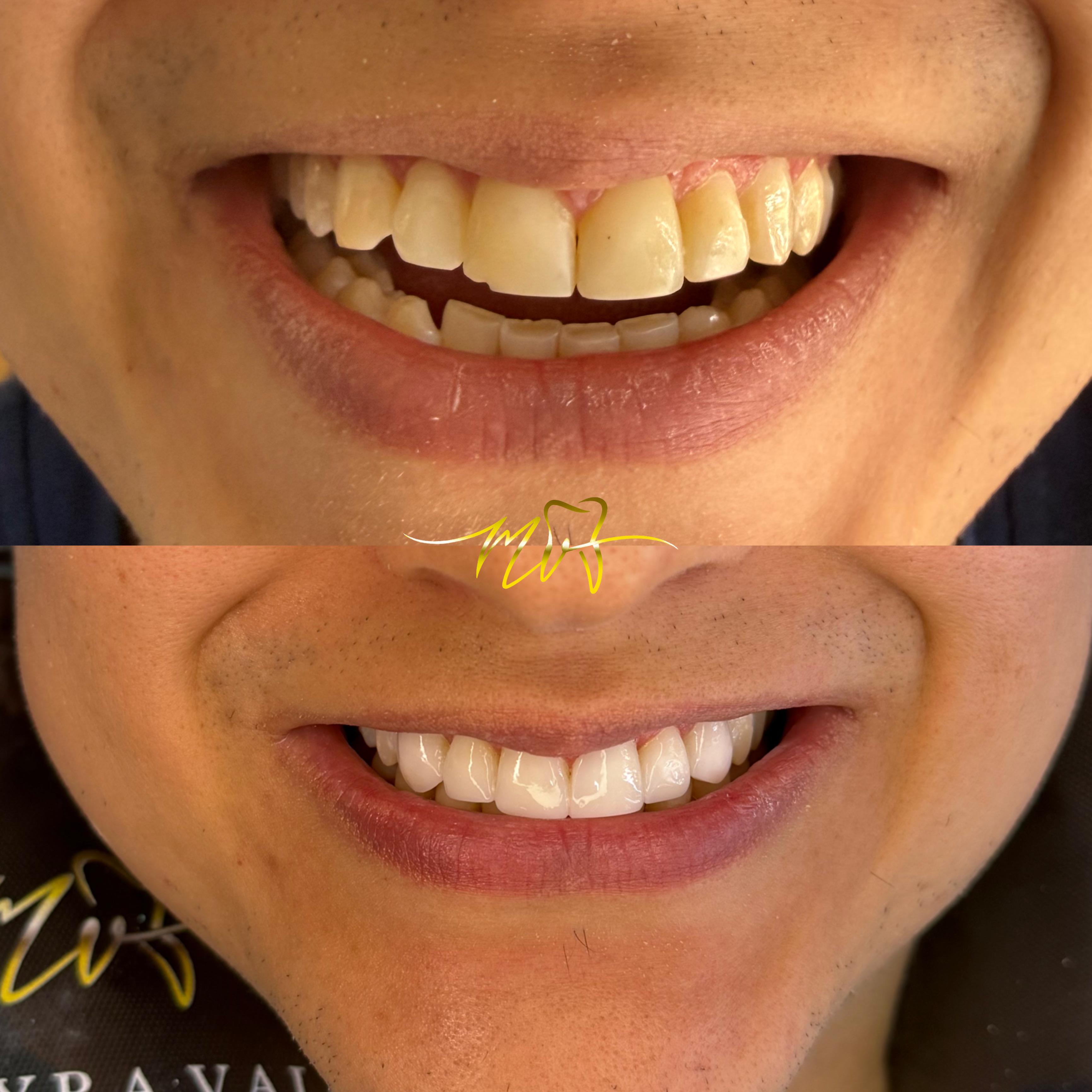 Caso de diseño de sonrisa, vista 3